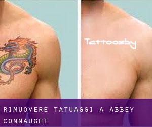 Rimuovere Tatuaggi a Abbey (Connaught)