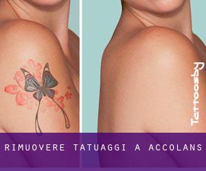 Rimuovere Tatuaggi a Accolans