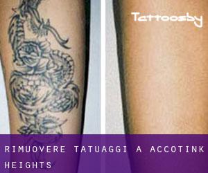 Rimuovere Tatuaggi a Accotink Heights