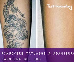 Rimuovere Tatuaggi a Adamsburg (Carolina del Sud)