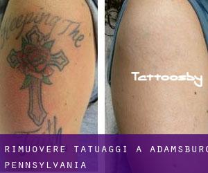 Rimuovere Tatuaggi a Adamsburg (Pennsylvania)