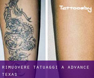 Rimuovere Tatuaggi a Advance (Texas)