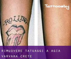 Rimuovere Tatuaggi a Agía Varvára (Crete)