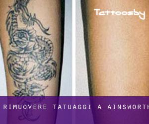 Rimuovere Tatuaggi a Ainsworth