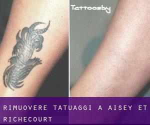 Rimuovere Tatuaggi a Aisey-et-Richecourt