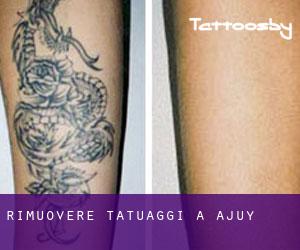 Rimuovere Tatuaggi a Ajuy