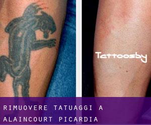 Rimuovere Tatuaggi a Alaincourt (Picardia)