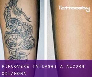 Rimuovere Tatuaggi a Alcorn (Oklahoma)