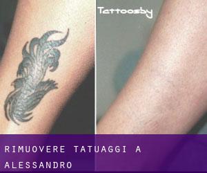 Rimuovere Tatuaggi a Alessandro