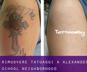 Rimuovere Tatuaggi a Alexander School Neighborhood