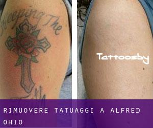 Rimuovere Tatuaggi a Alfred (Ohio)