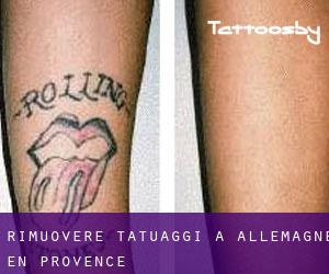 Rimuovere Tatuaggi a Allemagne-en-Provence