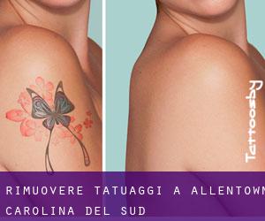 Rimuovere Tatuaggi a Allentown (Carolina del Sud)