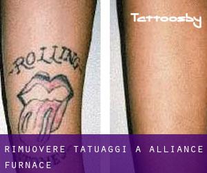 Rimuovere Tatuaggi a Alliance Furnace