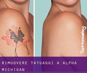 Rimuovere Tatuaggi a Alpha (Michigan)