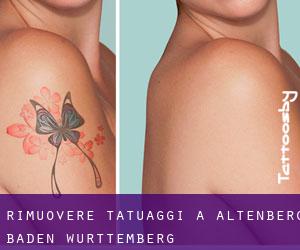 Rimuovere Tatuaggi a Altenberg (Baden-Württemberg)