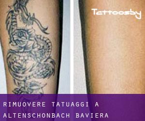 Rimuovere Tatuaggi a Altenschönbach (Baviera)