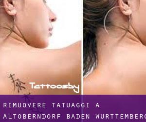 Rimuovere Tatuaggi a Altoberndorf (Baden-Württemberg)