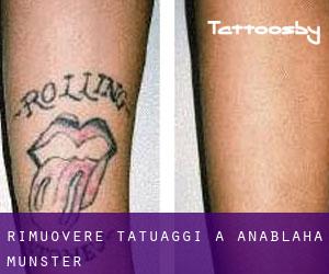 Rimuovere Tatuaggi a Anablaha (Munster)