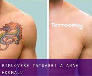 Rimuovere Tatuaggi a ‘Anae-ho‘omalu