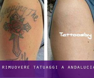 Rimuovere Tatuaggi a Andalucia