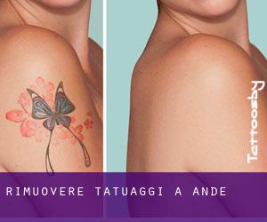 Rimuovere Tatuaggi a Andé