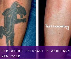 Rimuovere Tatuaggi a Anderson (New York)