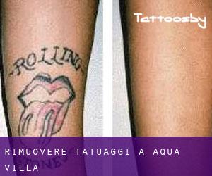 Rimuovere Tatuaggi a Aqua Villa