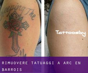 Rimuovere Tatuaggi a Arc-en-Barrois