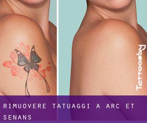 Rimuovere Tatuaggi a Arc-et-Senans