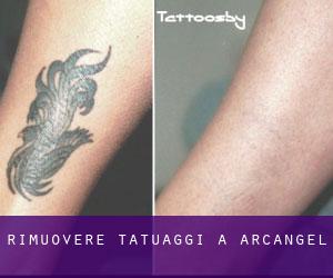 Rimuovere Tatuaggi a Arcangel