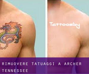 Rimuovere Tatuaggi a Archer (Tennessee)