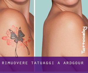 Rimuovere Tatuaggi a Ardgour
