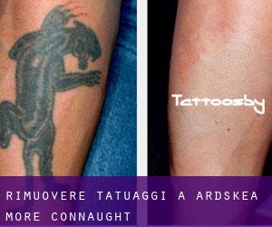 Rimuovere Tatuaggi a Ardskea More (Connaught)