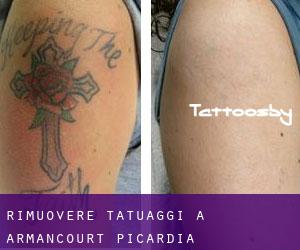 Rimuovere Tatuaggi a Armancourt (Picardia)