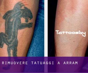 Rimuovere Tatuaggi a Arram