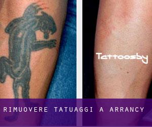 Rimuovere Tatuaggi a Arrancy