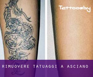 Rimuovere Tatuaggi a Asciano