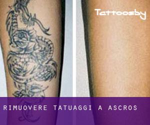 Rimuovere Tatuaggi a Ascros
