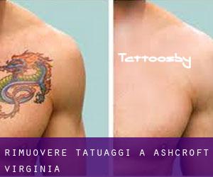Rimuovere Tatuaggi a Ashcroft (Virginia)