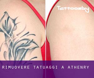 Rimuovere Tatuaggi a Athenry