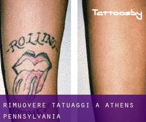 Rimuovere Tatuaggi a Athens (Pennsylvania)