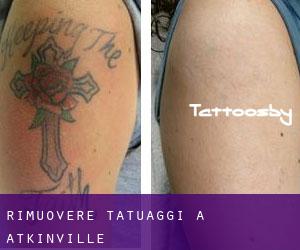 Rimuovere Tatuaggi a Atkinville