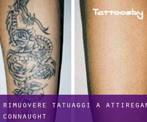 Rimuovere Tatuaggi a Attiregan (Connaught)