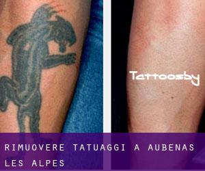 Rimuovere Tatuaggi a Aubenas-les-Alpes