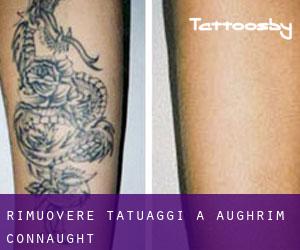 Rimuovere Tatuaggi a Aughrim (Connaught)