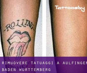 Rimuovere Tatuaggi a Aulfingen (Baden-Württemberg)