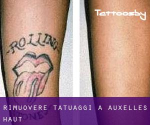 Rimuovere Tatuaggi a Auxelles-Haut