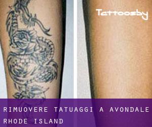 Rimuovere Tatuaggi a Avondale (Rhode Island)