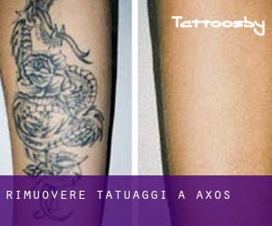 Rimuovere Tatuaggi a Axós